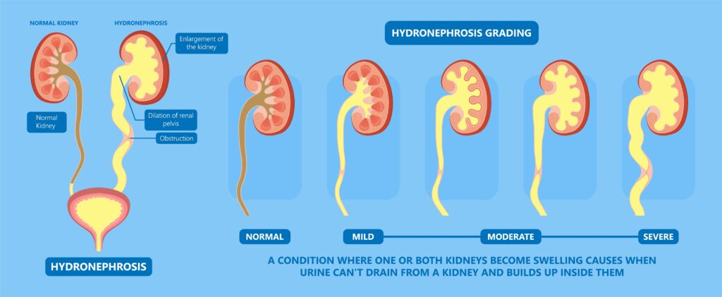 Renal Ultrasound Hydronephrosis Grading Renal Ultrasound Hydronephrosis Grading